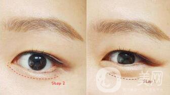 玻尿酸豐臥蠶術(shù)后護理怎么做