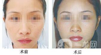 磨顴骨注意事項(xiàng)具體有哪些