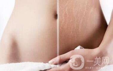 廣東激光去妊娠紋大概多少錢