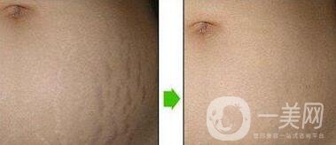 上海消除妊娠紋多少錢