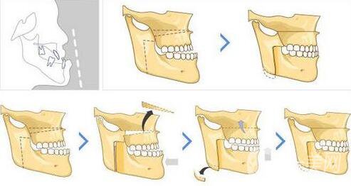 廣州做地包天矯正多少錢