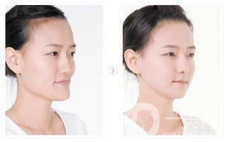 廣州做地包天矯正多少錢