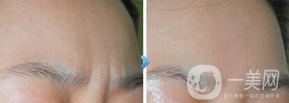 上海玻尿酸去眉間紋多少錢