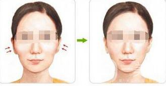 上海顴骨內(nèi)推價(jià)格是多少