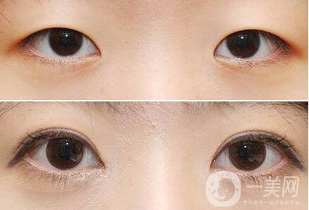 開(kāi)眼角*果,開(kāi)眼角注意事項(xiàng)