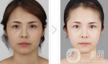 光纖溶脂好不好？?jī)r(jià)格是多少