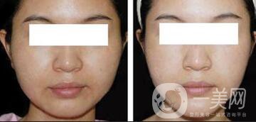 光纖溶脂好不好？?jī)r(jià)格是多少