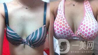 隆胸的危害有哪些