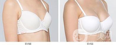 隆胸的危害有哪些 如何避免隆胸失敗
