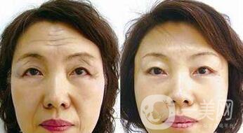 廈門做拉皮手術(shù)多少錢