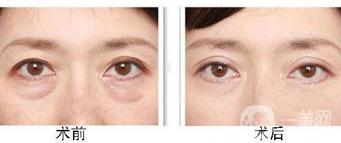 北京溶脂去眼袋價(jià)格是多少