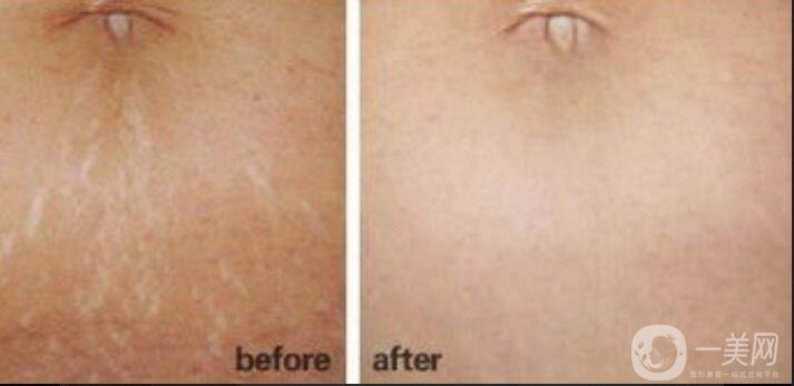 激光去妊娠紋多少錢,激光去妊娠紋術(shù)后護(hù)理