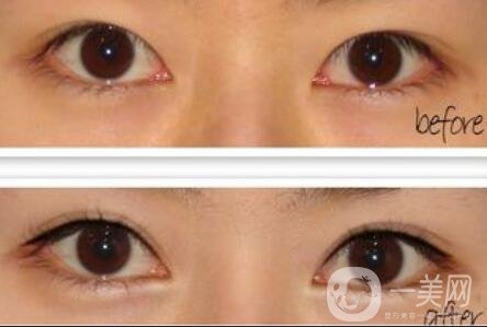 開眼角注意事項