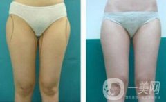 光纖溶脂瘦大腿會(huì)反彈嗎？術(shù)后注意事項(xiàng)介紹