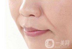 手術(shù)去法令紋果*維持嗎