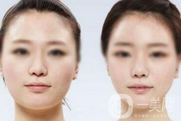 面部光纖溶脂好嗎？?jī)r(jià)格是多少