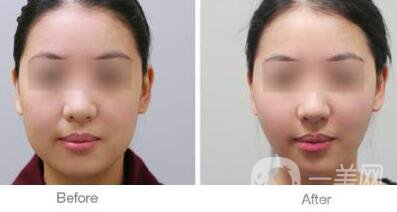 面部光纖溶脂好嗎？?jī)r(jià)格是多少