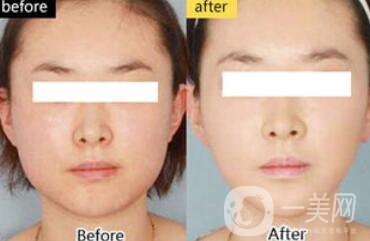 面部光纖溶脂好嗎？?jī)r(jià)格是多少