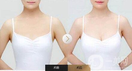 隆胸后怎么護(hù)理？術(shù)前怎么準(zhǔn)備？