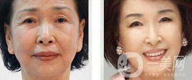 汕頭電波拉皮除皺多少錢(qián)