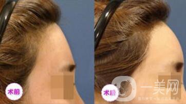 廣東自體脂肪填充額頭多少錢