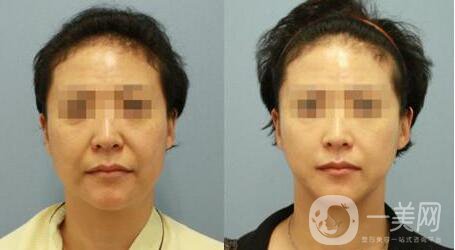 埋線拉皮用的什么線 術(shù)后要注意些什么