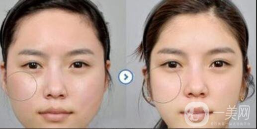 磨顴骨后遺癥,磨顴骨術(shù)后護(hù)理