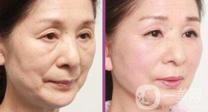 拉皮除皺能堅持幾年？與哪些因素有關？