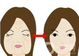 拉皮除皺能堅持幾年？與哪些因素有關？