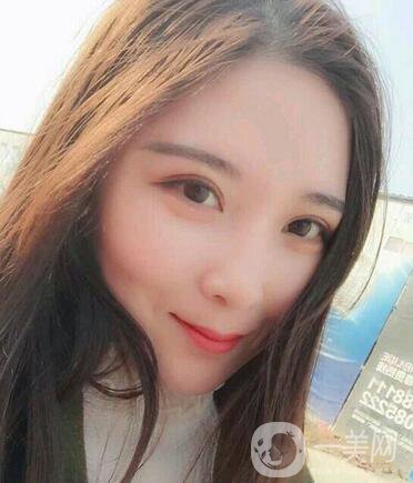 全開雙眼皮和開眼角