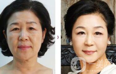 拉皮能維持多久？拉皮的價(jià)格是多少