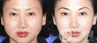 拉皮能維持多久？拉皮的價(jià)格是多少