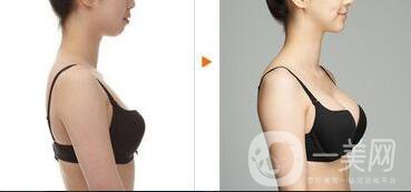 假體隆胸材料有哪些？*果怎么樣