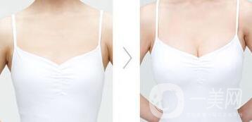 假體隆胸材料有哪些？*果怎么樣