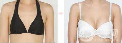 假體隆胸材料有哪些？*果怎么樣