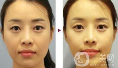 自體脂肪去法令紋*果怎么樣