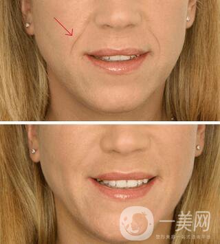 上海自體脂肪填充法令紋多少錢？