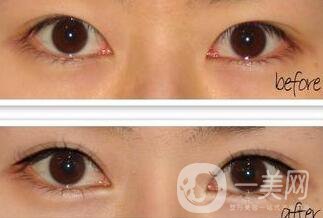 北京超聲波乳化去眼袋價(jià)格,超聲波去眼袋價(jià)格