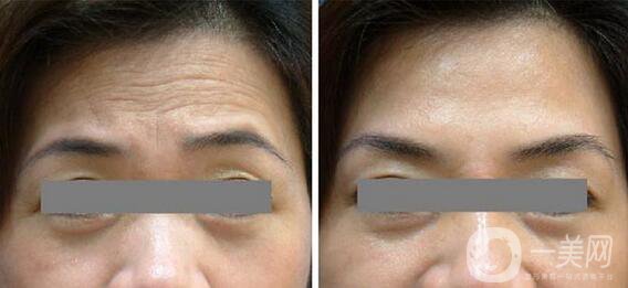 深圳做熱瑪吉多少錢及術(shù)后護理介紹