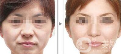 江蘇微波拉皮價(jià)格是多少