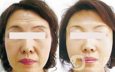 電波拉皮*果怎么樣呢？價格高嗎