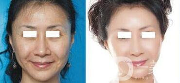 電波拉皮*果怎么樣呢？價格高嗎