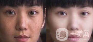 果酸換膚好嗎？果酸換膚有副作用嗎