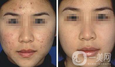 果酸換膚好嗎？果酸換膚有副作用嗎