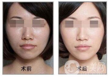 果酸換膚好嗎？果酸換膚有副作用嗎