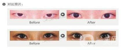 開眼角手術(shù)要花多少錢 價(jià)格貴不貴
