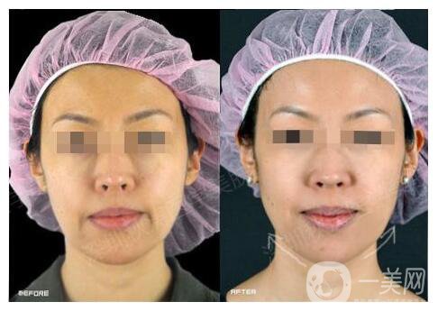 深圳臉部電波拉皮價格 費用需要多少錢