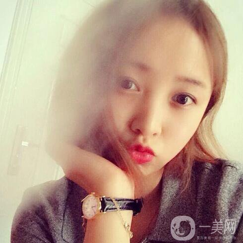 玻尿酸去魚尾紋價(jià)格 去魚尾紋費(fèi)用多少錢