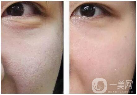 玻尿酸去魚尾紋價(jià)格 去魚尾紋費(fèi)用多少錢