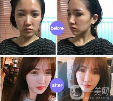 上海*價格 面部提升要多少錢